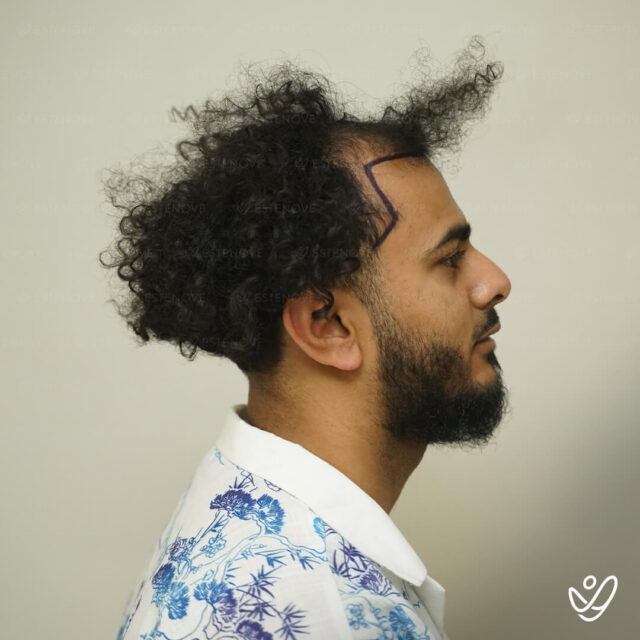 Hossam before - 3